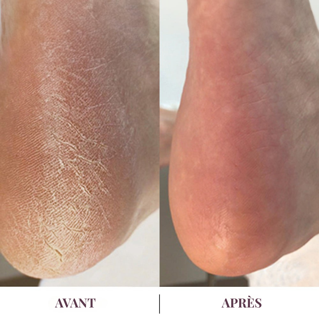 Dermalis™ | Des talons doux, sans passer par l’institut