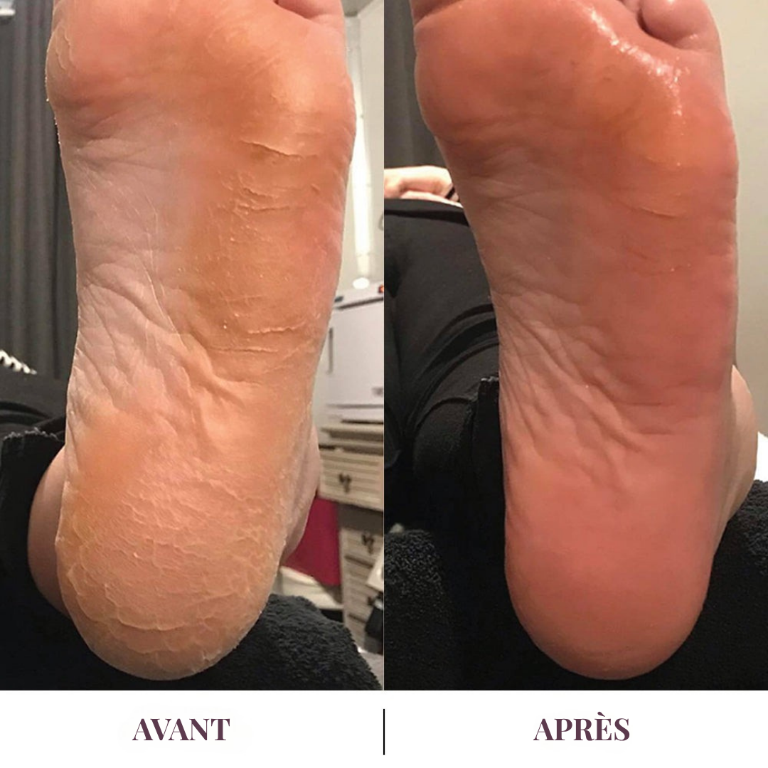 Dermalis™ | Des talons doux, sans passer par l’institut