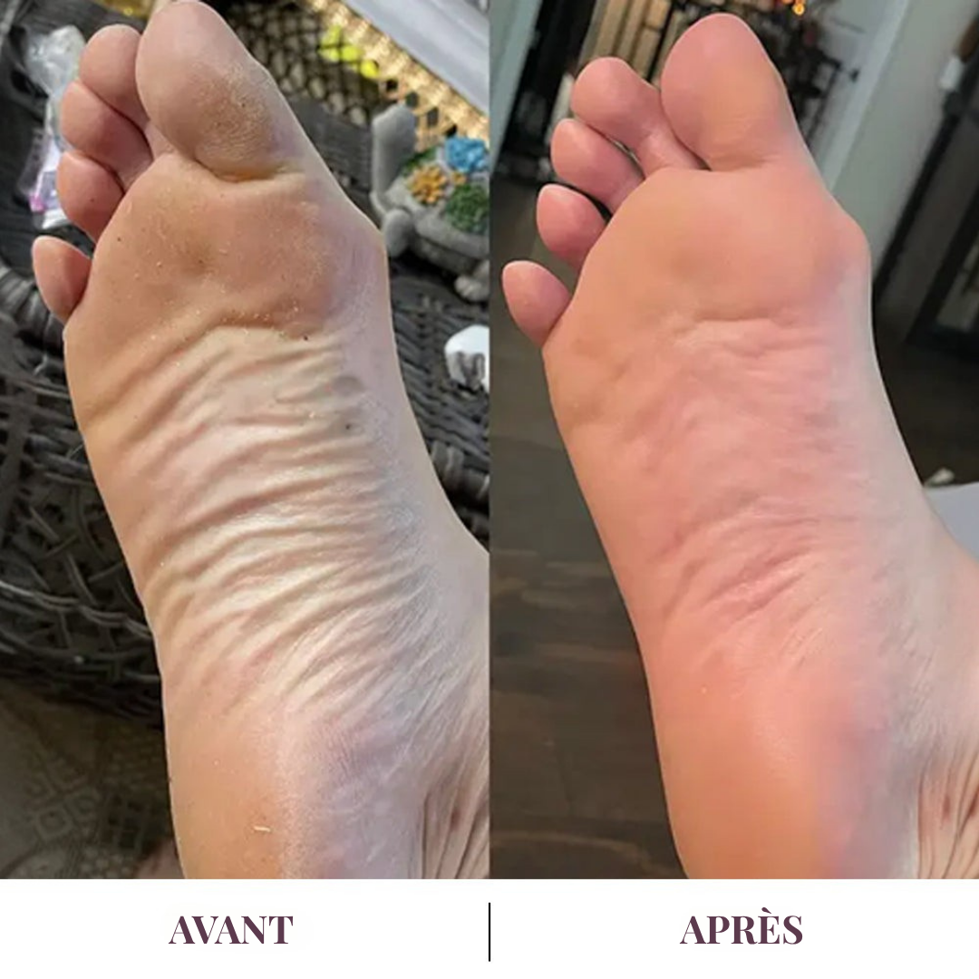 Dermalis™ | Des talons doux, sans passer par l’institut