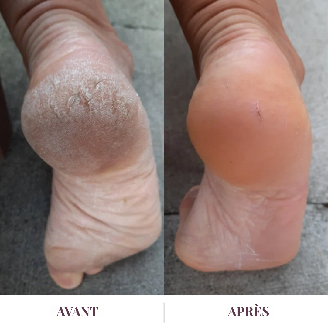 Dermalis™ | Des talons doux, sans passer par l’institut
