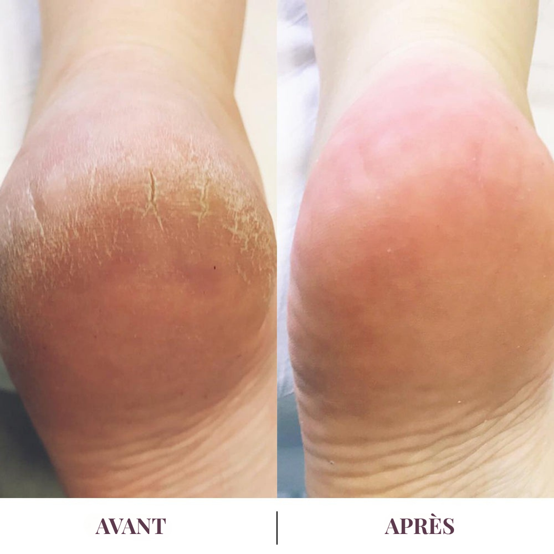 Dermalis™ | Des talons doux, sans passer par l’institut